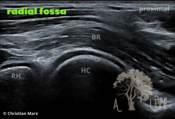 radial fossa