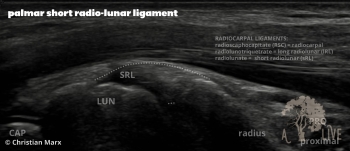 palmar short radio-lunar ligament