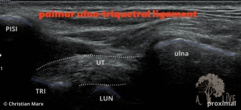 TFCC: ulno-triquetral ligament