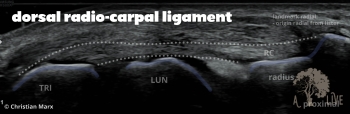 dorsal radio-carpal ligament
