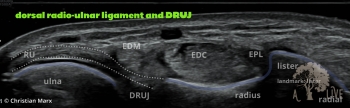 dorsal radio-ulnar ligament and DRUJ