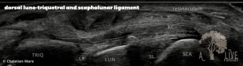 dorsal luno-triquetral and scapholunar ligament