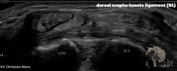 dorsal scapho-lunar ligament (SL)