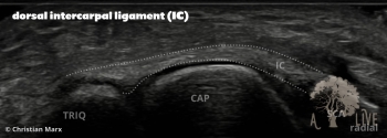 dorsal intercarpal ligament (IC)