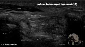 palmar intercarpal ligament (IC) complete