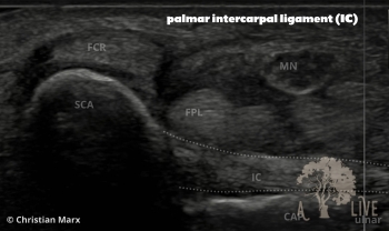 palmar intercarpal ligament (IC)