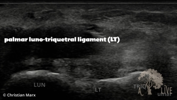 hand-us-palmar-LT-ligament-title