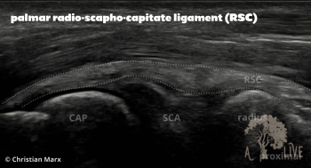 palmar radio-scapho-capitate ligament (RSC)