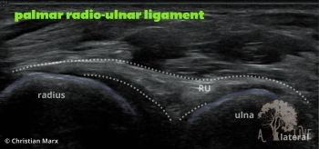 palmar radio-ulnar ligament