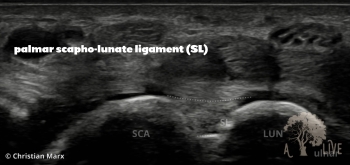 palmar scapho-lunate ligament (SL)