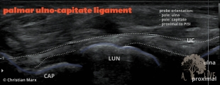 palmar ulno-capitate ligament