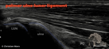 palmar ulno-lunar ligament