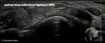 palmar long radio-lunar ligament