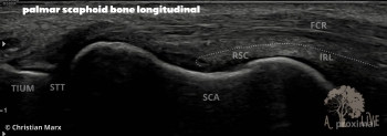 palmar scaphoid bone longitudinal