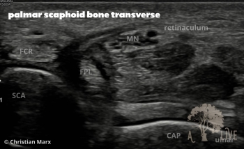 palmar scaphoid bone transverse