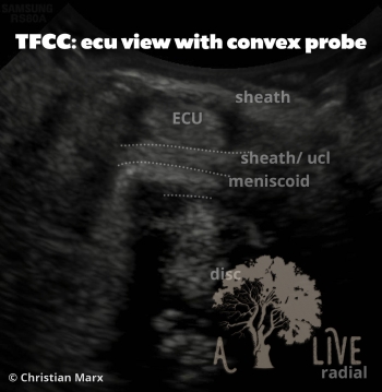 TFCC: ECU window transverse view (convex probe)