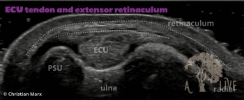 ECU tendon and extensor retinaculum