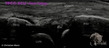 TRIQ=triquetrum; PSU=styloid process ulna; LUN=lunate; UCL=ulnocollateral ligament, ECU=extensor carpi ulnaris
