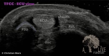 TFCC: ECU window transverse view