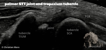 palmar STT joint and trapezium tubercle