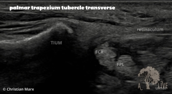 palmar trapezium tubercle transverse
