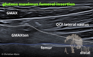 gluteus maximus femoral insertion