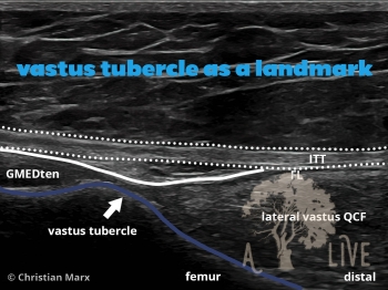 vastus tubercle as a landmark