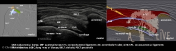 shoulder injection lateral subacromial bursa