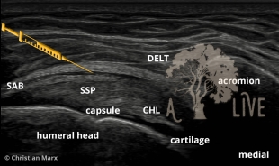 shoulder-us-injection-SAB-lateral-title