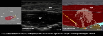 shoulder injection suprascapular nerve fossa