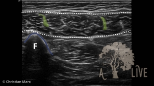 soleus muscle transverse view