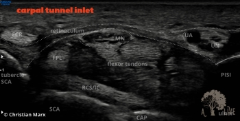 carpal tunnel inlet