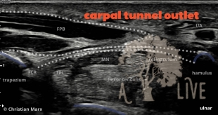 carpal tunnel outlet