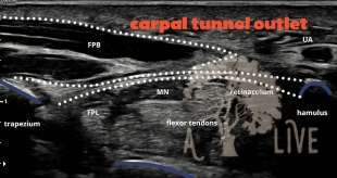carpal tunnel outlet