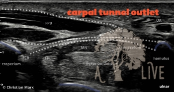 carpal tunnel outlet